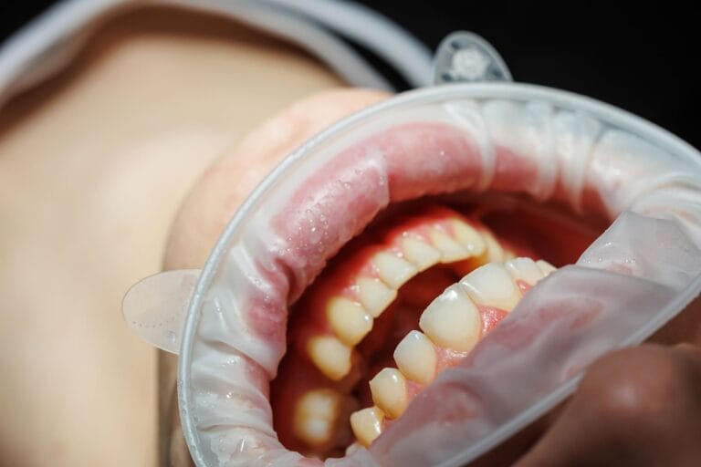 Parodontite cronica Parodontite cronica